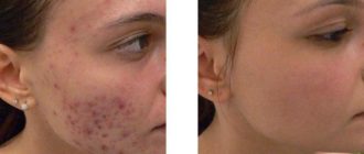 Эффезел гель и удаление лазером