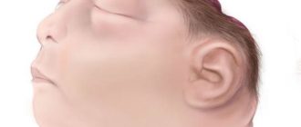 ВПР: экзэнцефалия, акрания