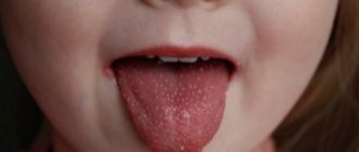 На языке высыпание и белое пятно