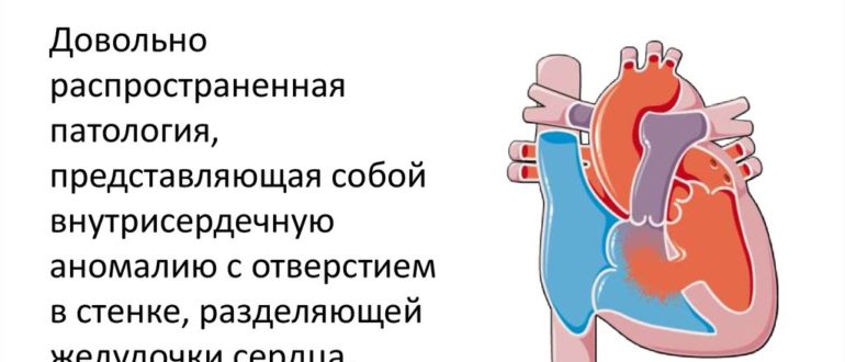Дефект межжелудочковой перегородки