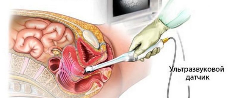 Узи матки и придатков