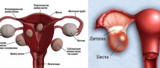 Миома матки интрамуральная, фоликулярная киста левого яичника