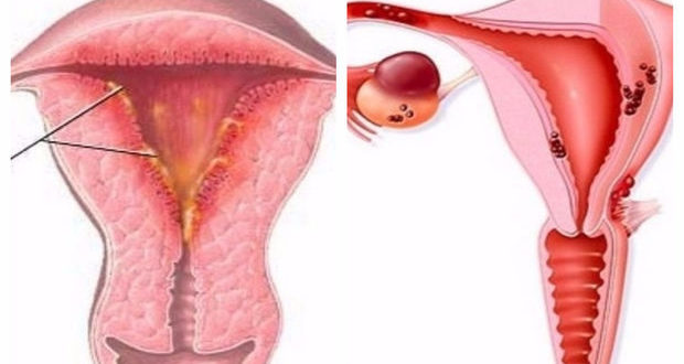 Вялотекущий эндометрит