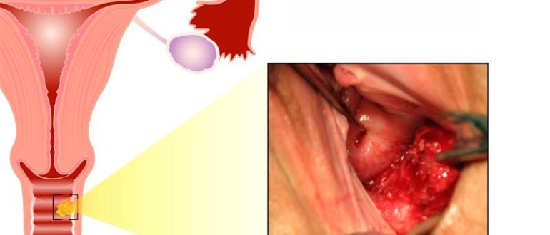 Воспаление входа влагалища