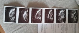 Узи не показывает беременность, задержка тест положительный