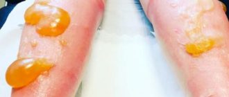 Дерматит после химического ожога