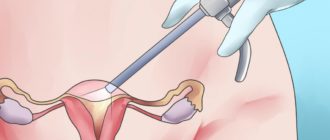 Выделения после операции