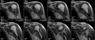 МРТ плечевого сустава