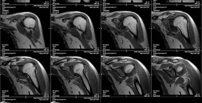 МРТ плечевого сустава