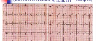 Нарушение кровообращения задней стенки