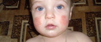 Дисбактериоз и аллергия