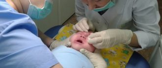 Дакриоцистит. Зондирование