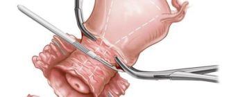 Дисплазия шейки матки конизация