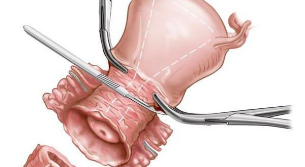 Дисплазия шейки матки конизация
