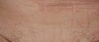 Выпадение волос в области паха