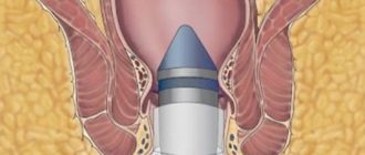 Долго ли болит попа после анального секса?