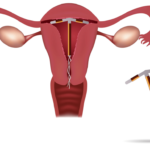 Нарушение цикла из-за приёма аскорутина или же возможная беременность?