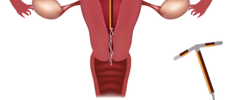 Внутриматочная спираль и боль внизу живота