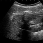 Эндометрий на 9 день после аборта