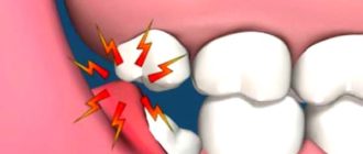 Вич, хламидии, или зубы мудрости?