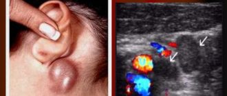 Выраженная гиперплазия лимфатических узлов