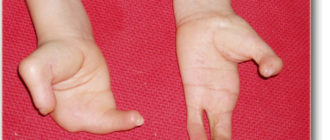 Врожденный дефект недоразвития четвертых пальцев ног