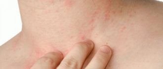 Чем лечить зуд при лямблиозе?