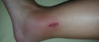 Воспаление пореза