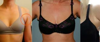 Долька молочной железы подмышкой