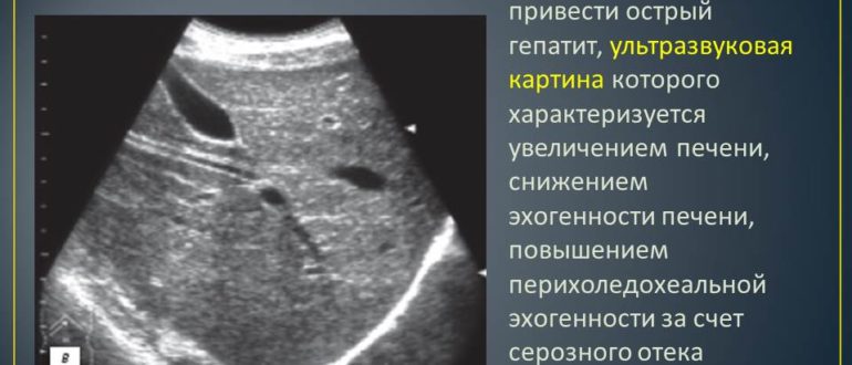 Узи брюшной полости. Повышенная эхогенность печени у ребёнка