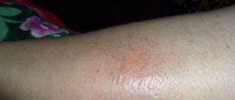 На икрах ног появились красные пятна с пузырьками - гнойнички