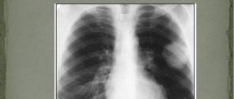 Дополнительная тень в легких