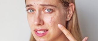 Демодекоз у беременной