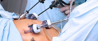 Эндометриоз после лапароскопии