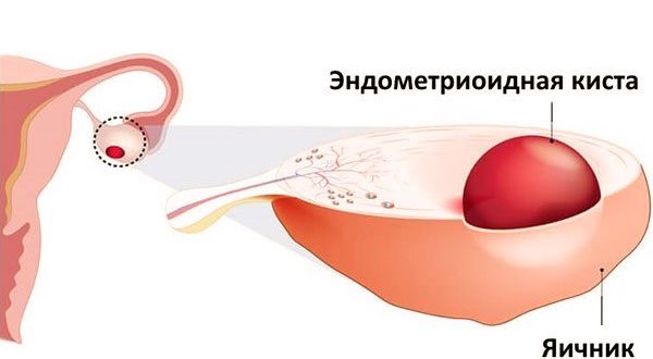 Дюфастон и эндометриоиная киста пр. Яичника