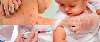 Можно ли заболеть ветрянкой после прививки однократно (взрослый)