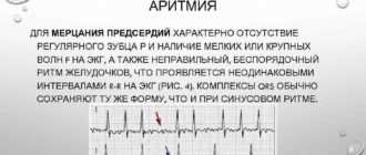 Мерцательная аритмия: пароксизмальная форма фибриляции предсердий-Эгилок или Беталок Зок?