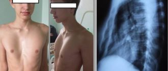 Деформация грудной клетки является преградой для поступления в военный ВУЗ?