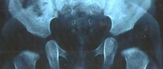 Узи ТБС - отсутствие ядер окостенения