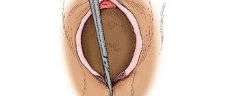 Внальная трещина после родов