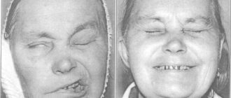 Менингиома, после операции парез лицевого нерва