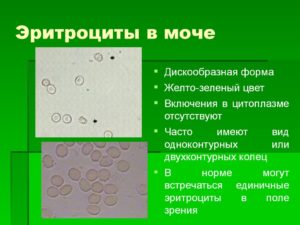 Высокая температура и эритроциты в моче