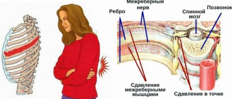 Может ли это быть межреберная невралгия?