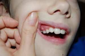 Нарост на десне около зуба