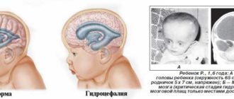Вентрикуломегалия у грудничка