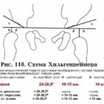 Мозаицизм 12 хромосомы