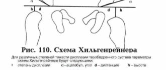 В норме ли ацетабулярные индексы