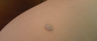 Наросты на ягодицах