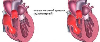 Дисфункция клапана лёгочной артерии