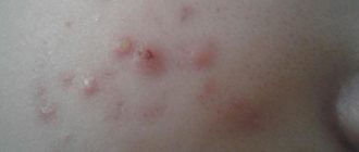 Водянисто-белые прыщики на шее